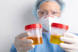 nurse wearing a mask holding two urine samples.